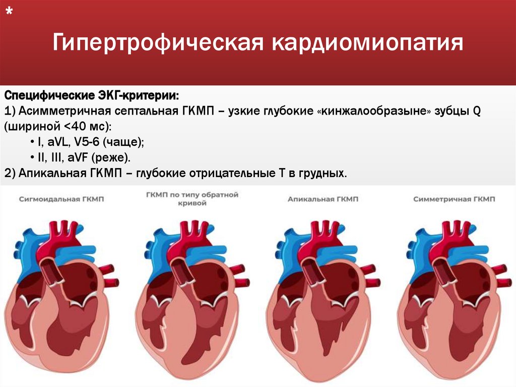 Гипертрофическая кардиомиопатия