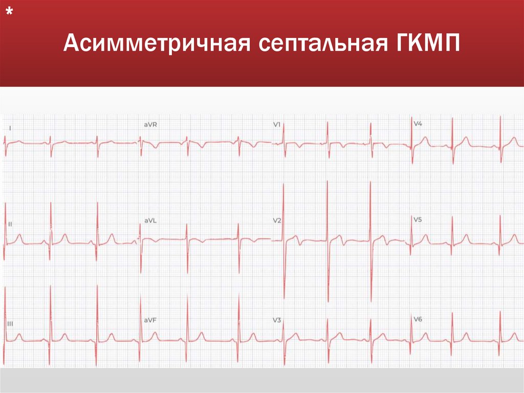 Асимметричная септальная ГКМП