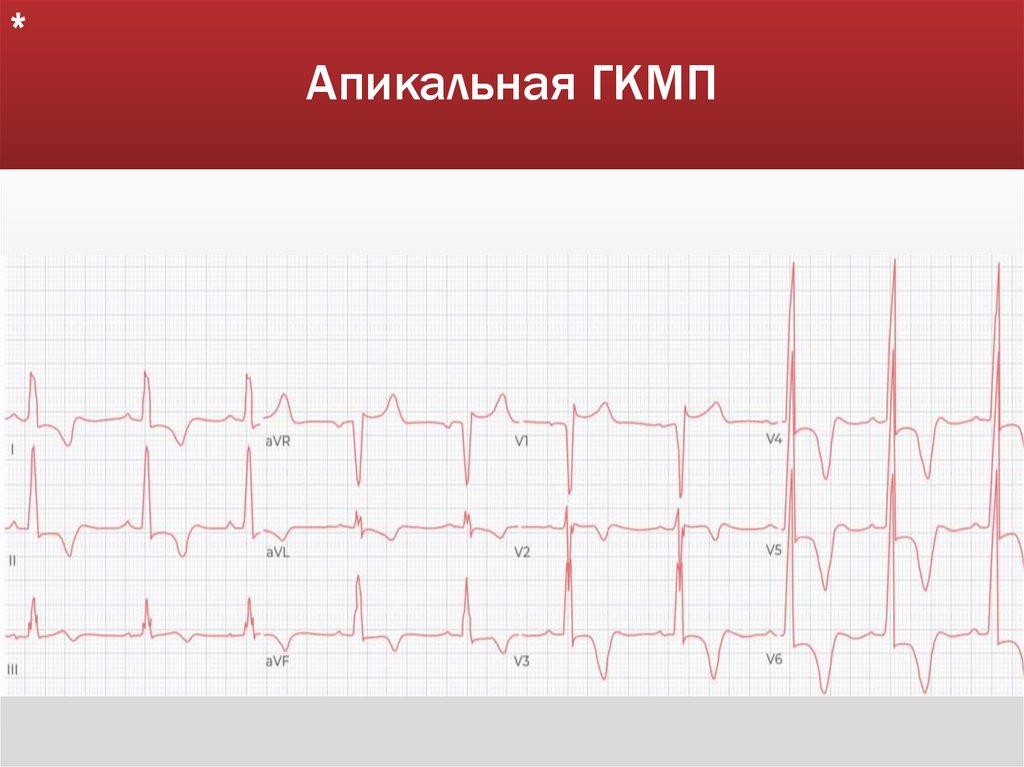 Апикальная ГКМП