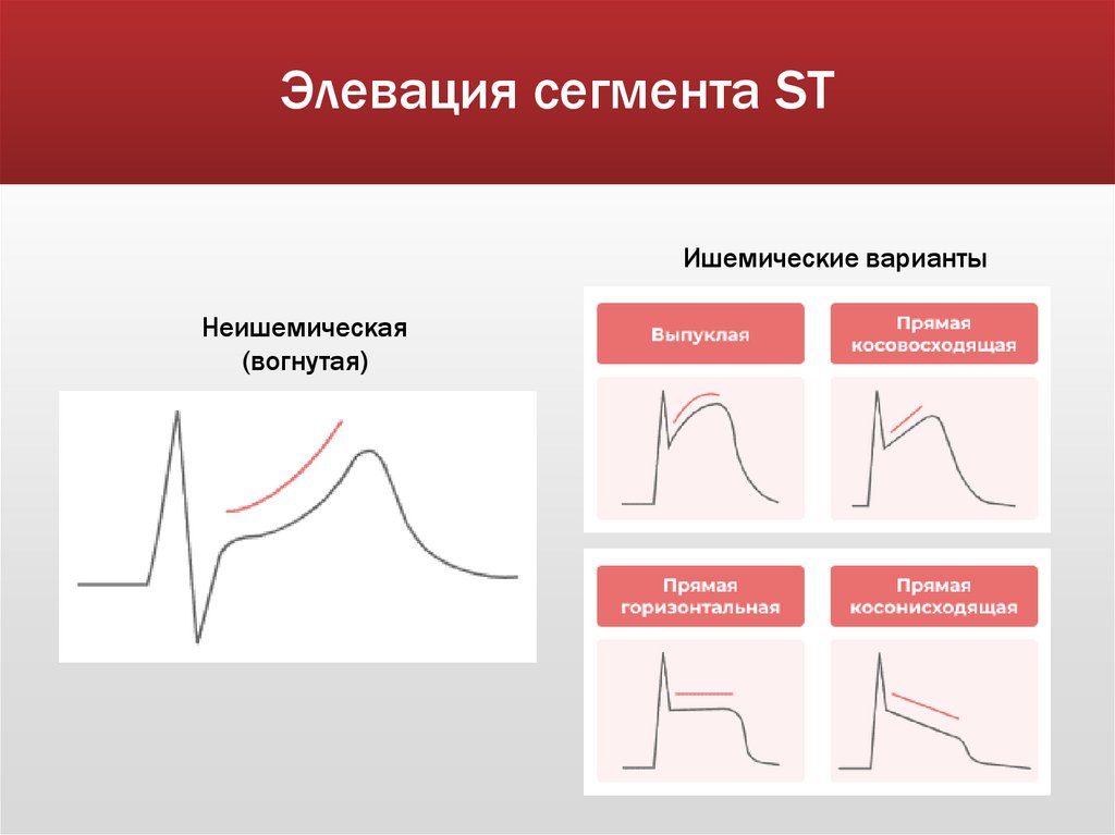 Элевация сегмента ST
