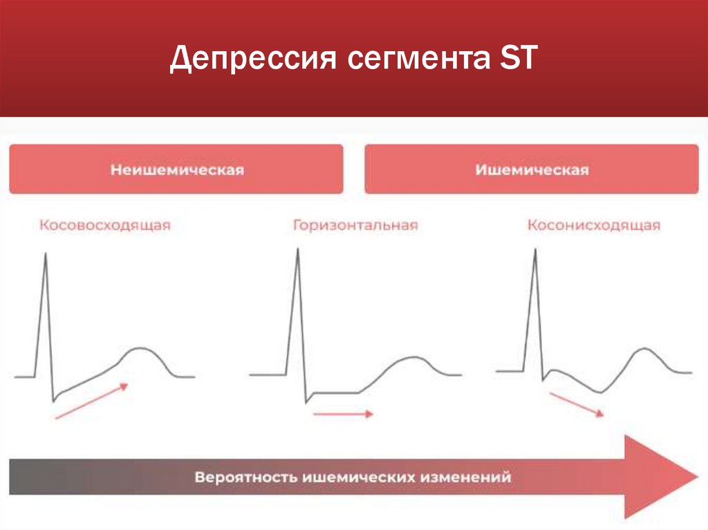 Депрессия сегмента ST