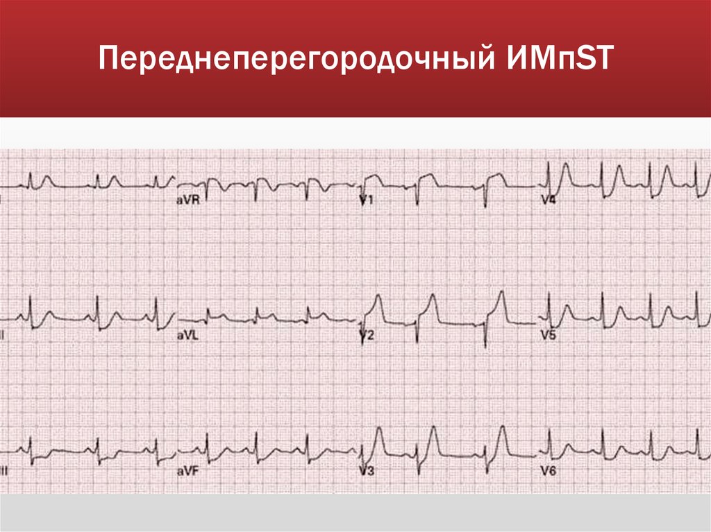 Переднеперегородочный ИМпST