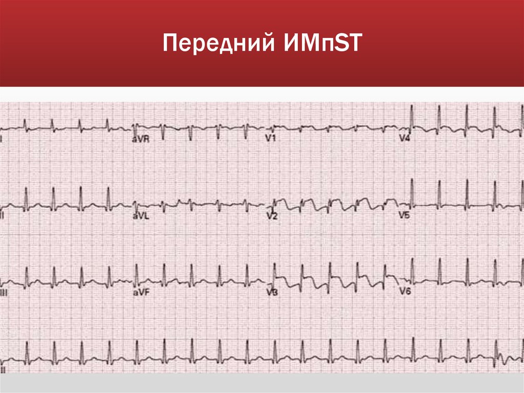 Передний ИМпST
