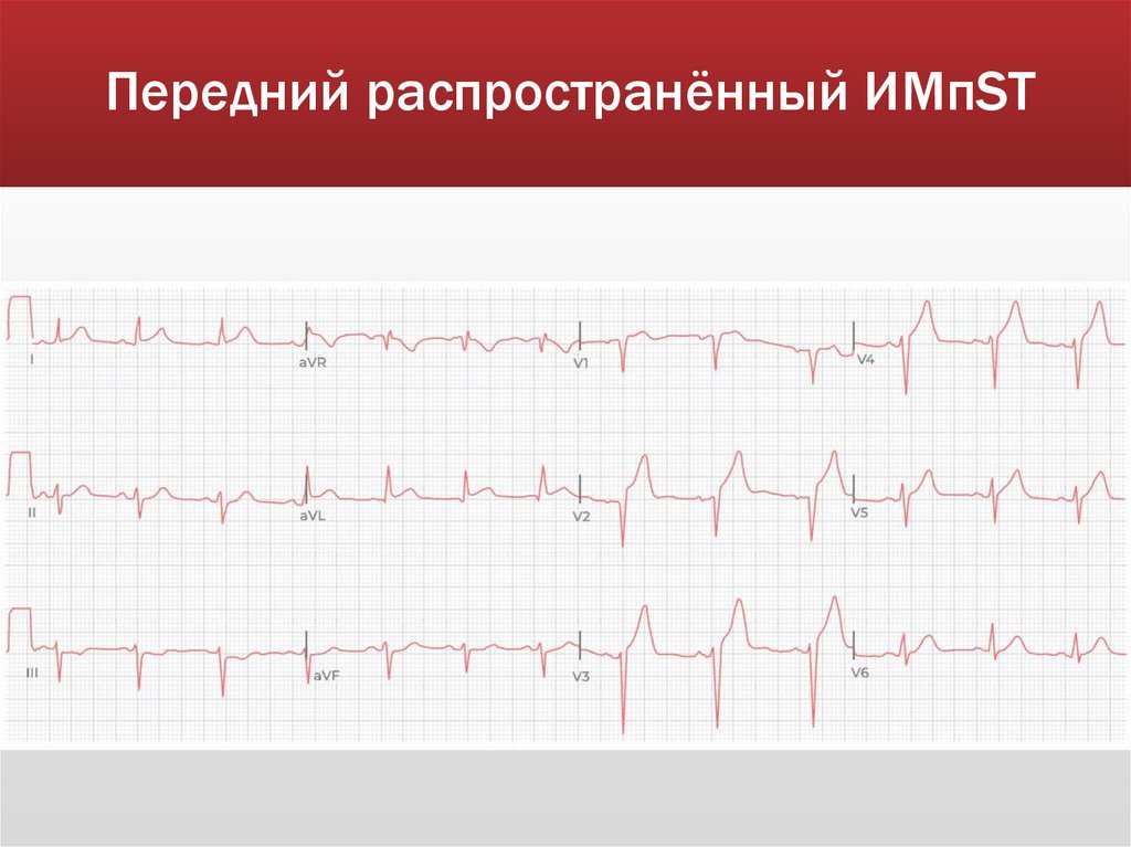 Передний распространённый ИМпST