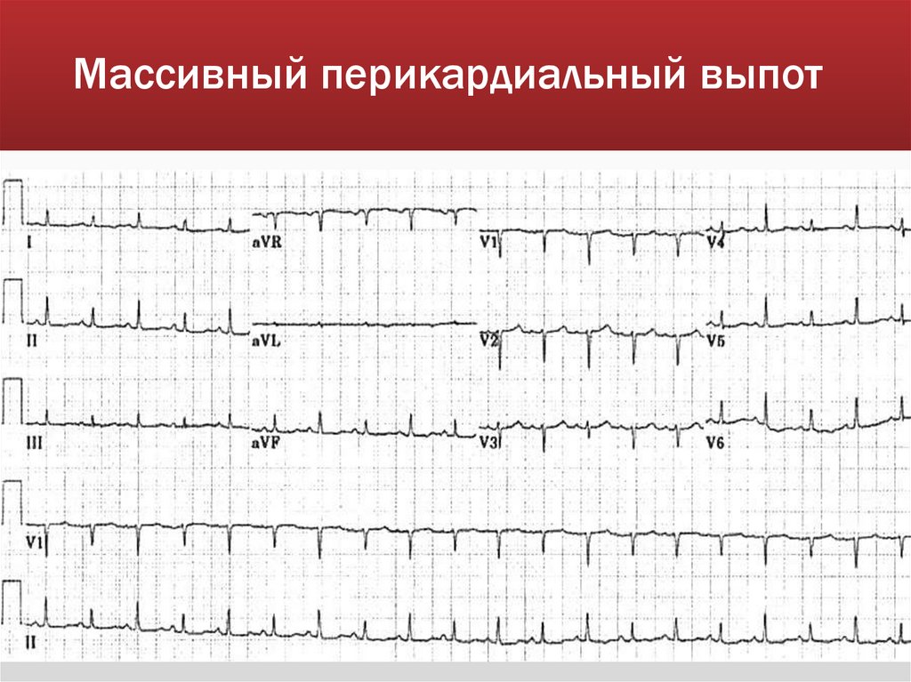 Массивный перикардиальный выпот