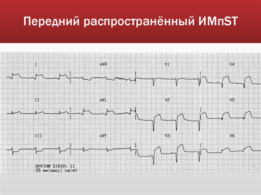 Передний распространённый ИМпST