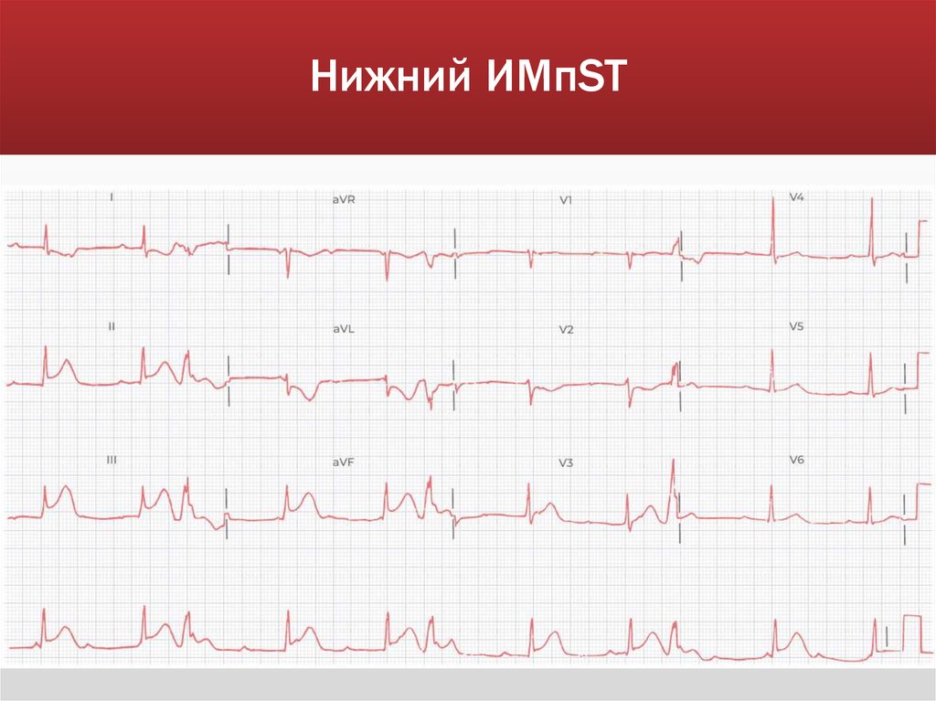 Нижний ИМпST