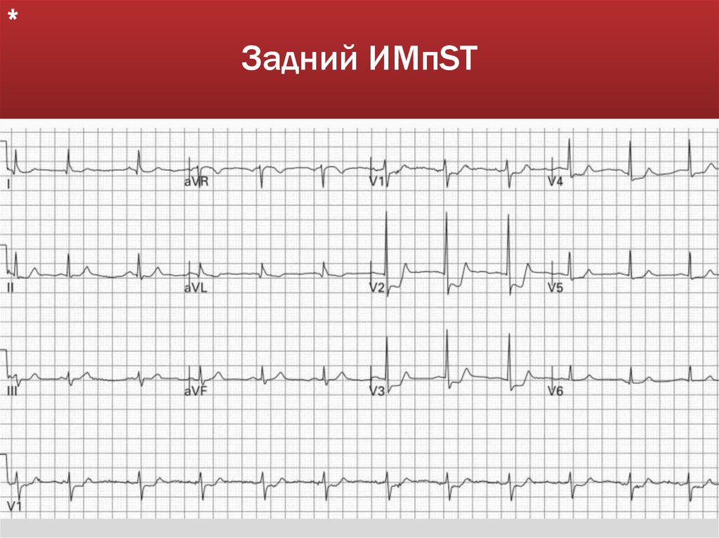 Задний ИМпST