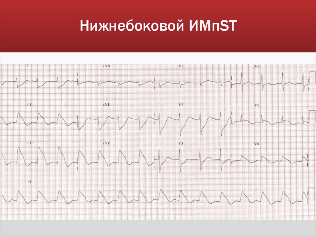 Нижнебоковой ИМпST
