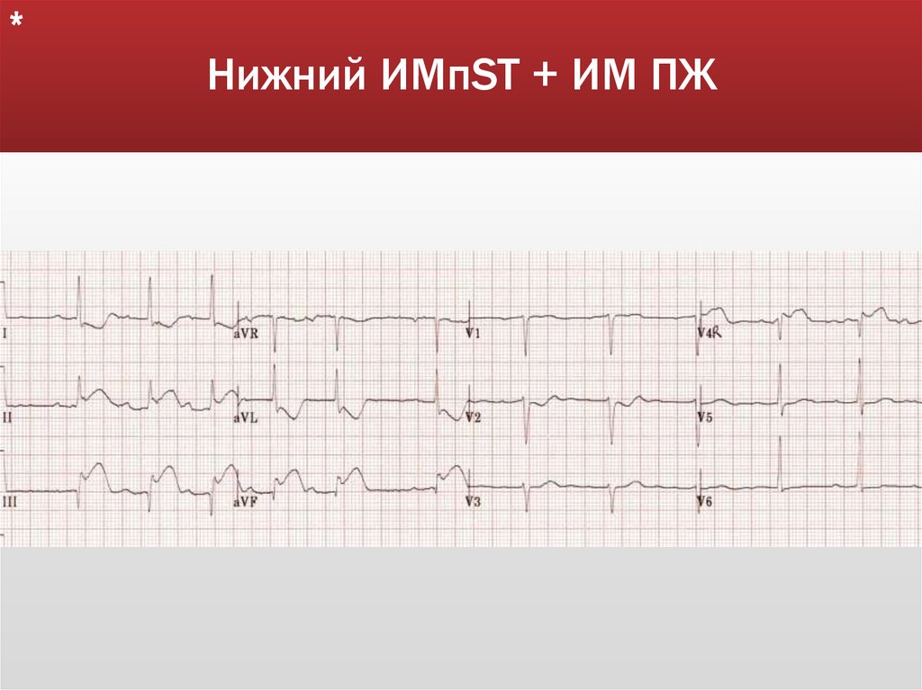 Нижний ИМпST + ИМ ПЖ