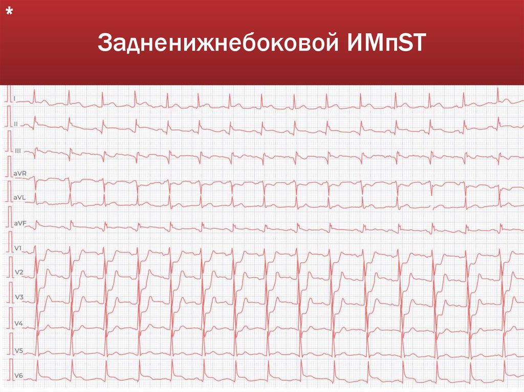 Задненижнебоковой ИМпST