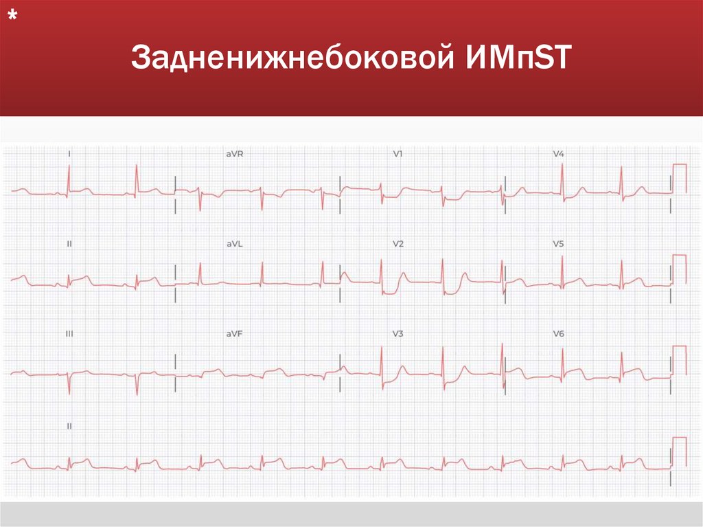 Задненижнебоковой ИМпST