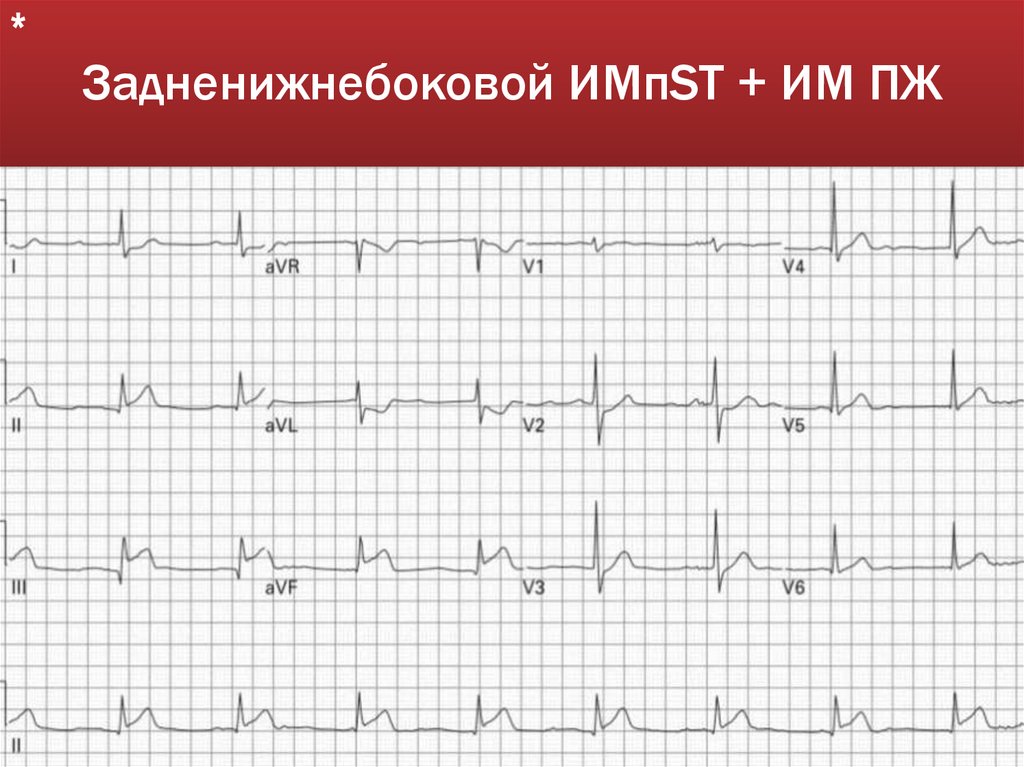 Задненижнебоковой ИМпST + ИМ ПЖ
