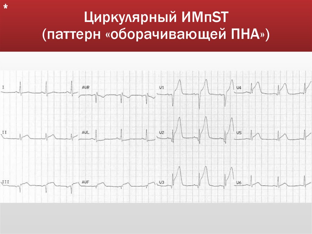 Циркулярный ИМпST (паттерн «оборачивающей ПНА»)