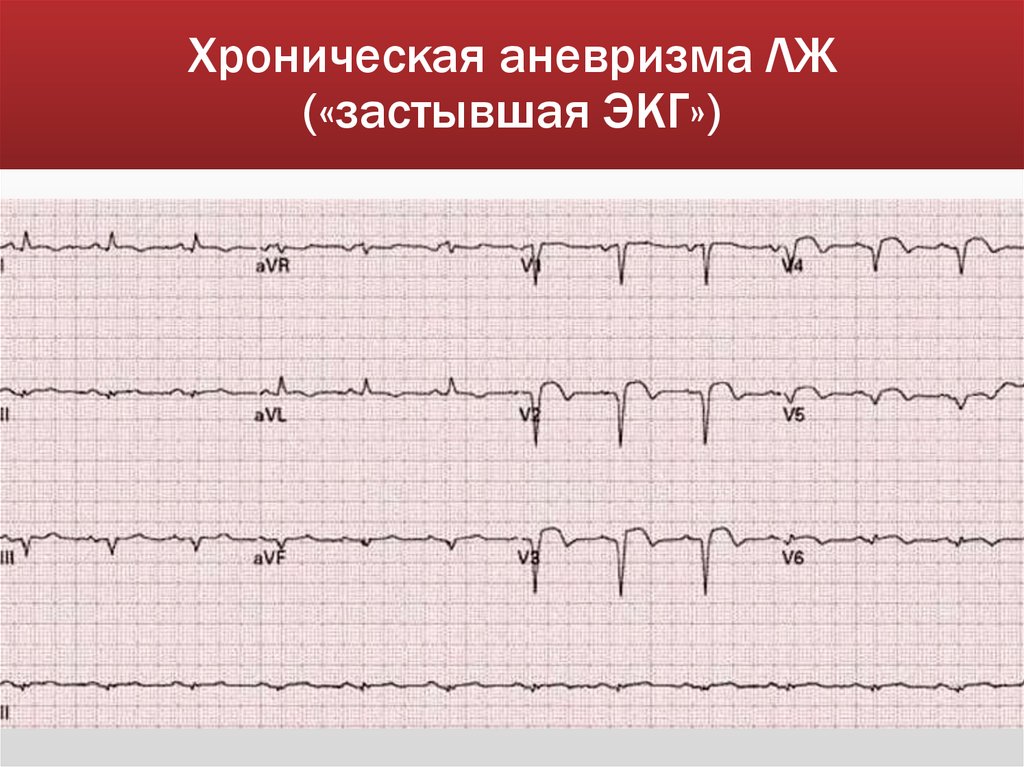 Хроническая аневризма ЛЖ («застывшая ЭКГ»)