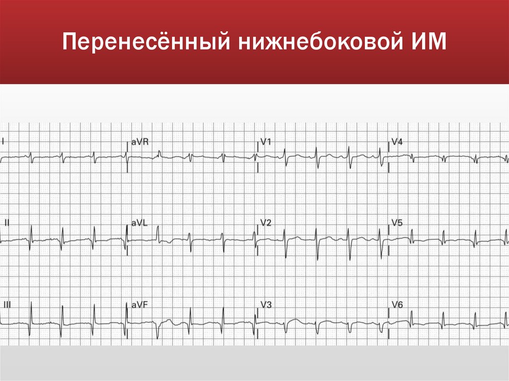 Перенесённый нижнебоковой ИМ