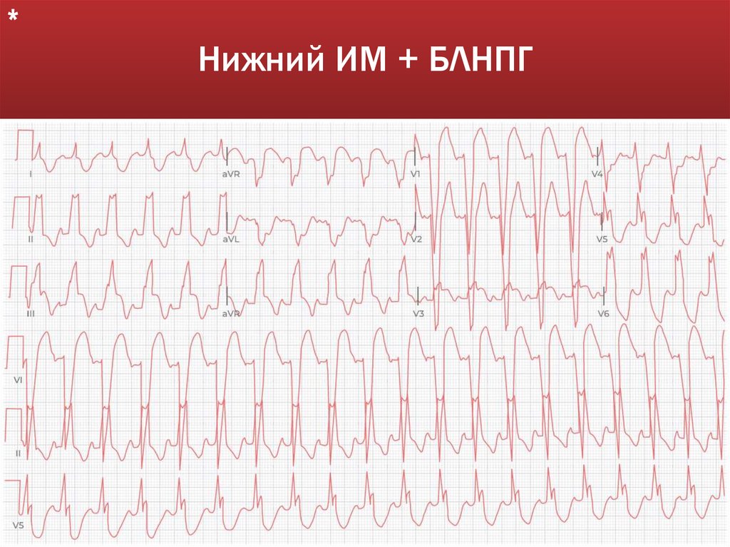 Нижний ИМ + БЛНПГ