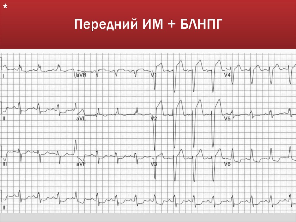 Передний ИМ + БЛНПГ