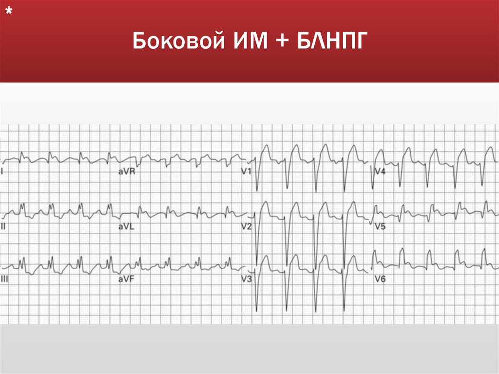 Боковой ИМ + БЛНПГ