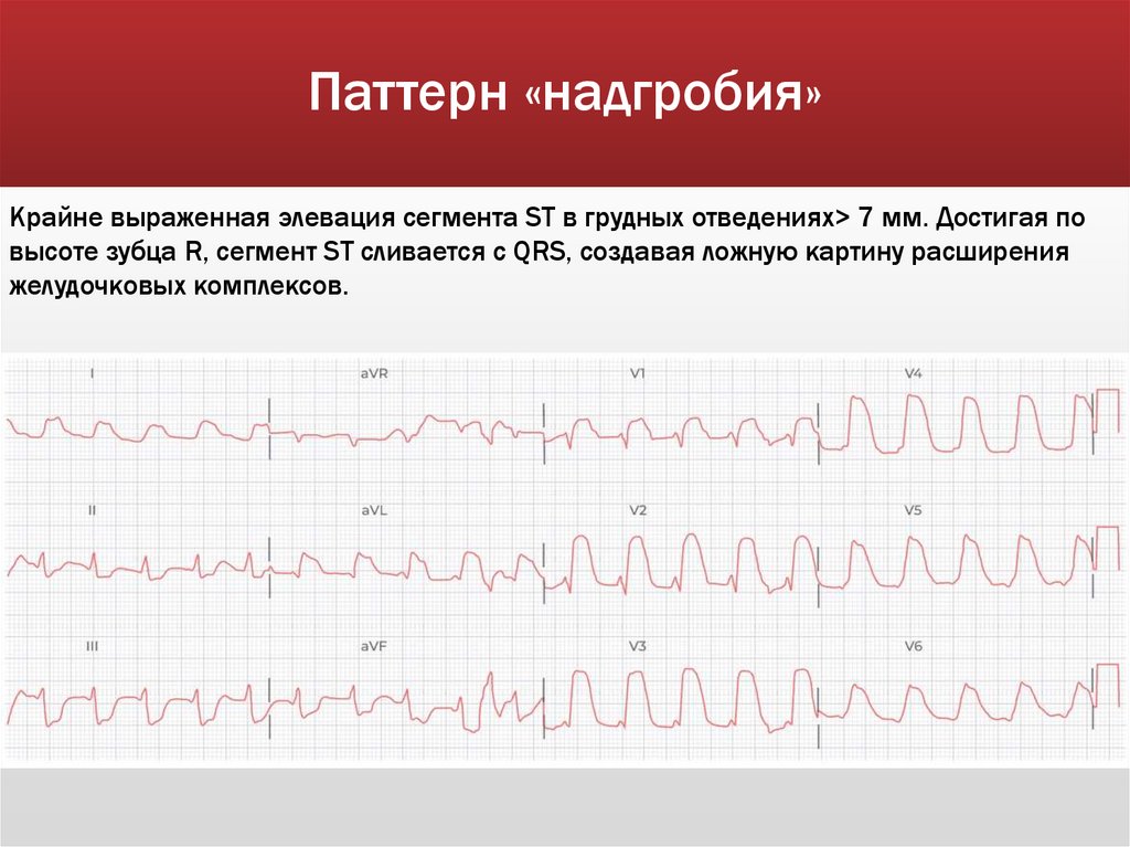 Паттерн «надгробия»