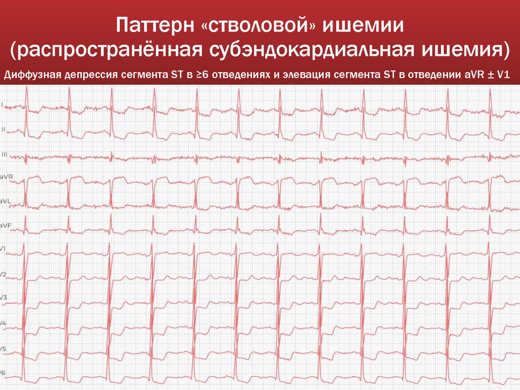 Паттерн «стволовой» ишемии (распространённая субэндокардиальная ишемия)