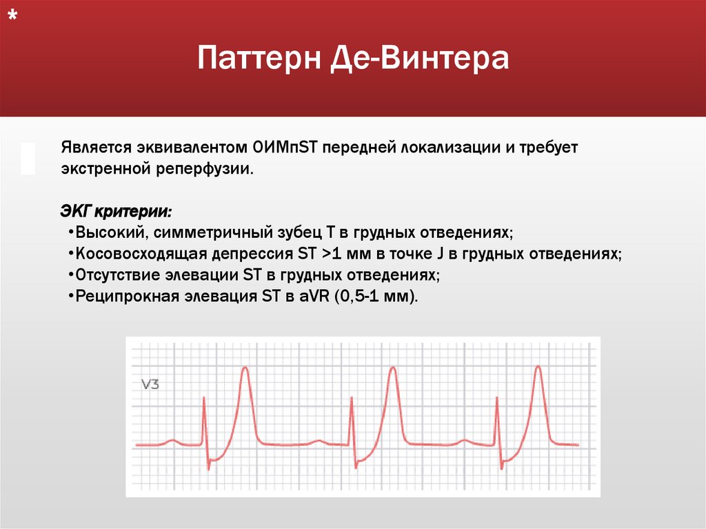 Паттерн Де-Винтера