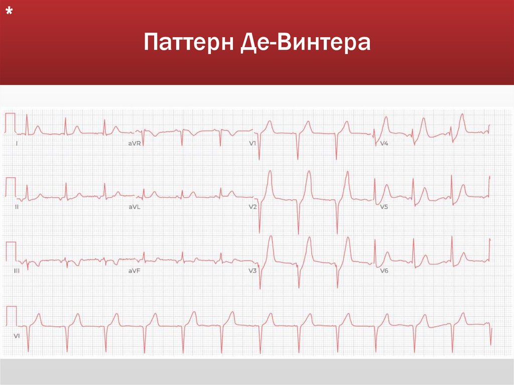 Паттерн Де-Винтера