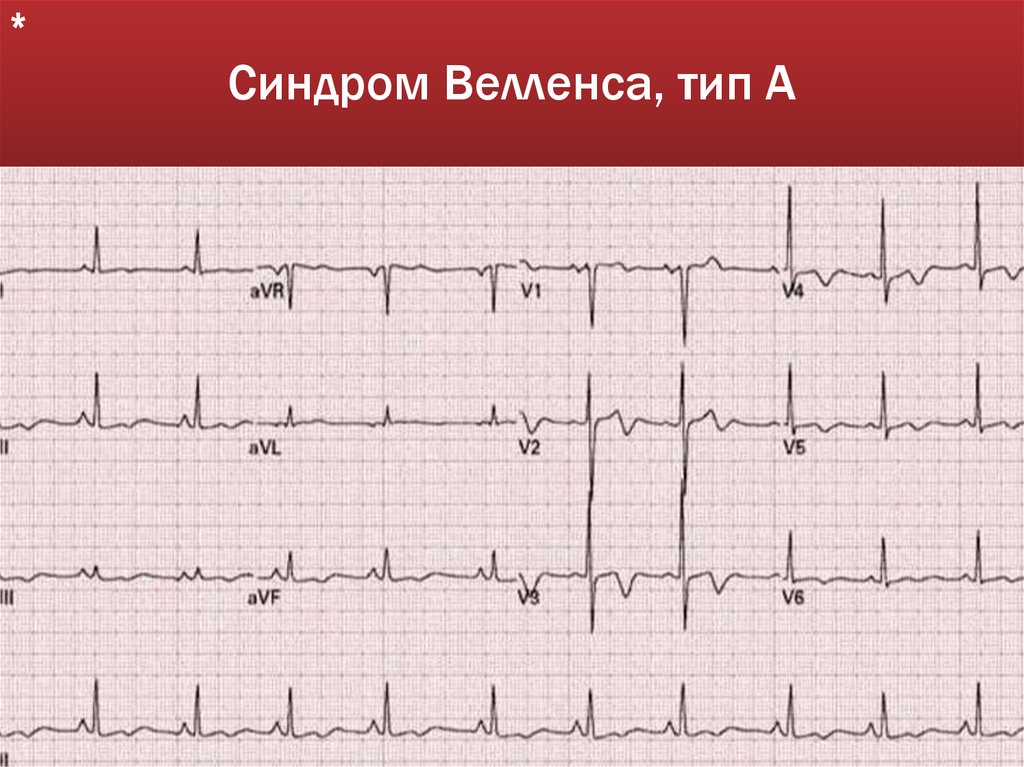 Синдром Велленса, тип А