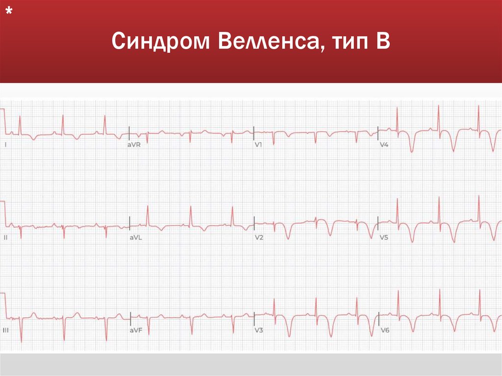 Синдром Велленса, тип В
