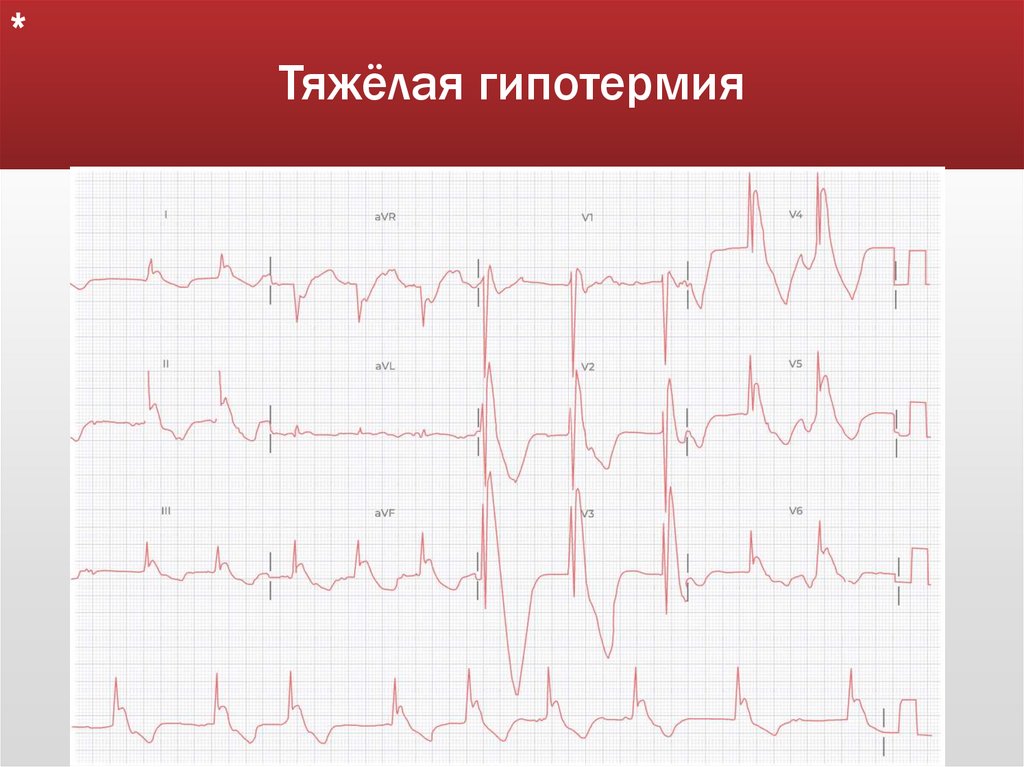 Тяжёлая гипотермия