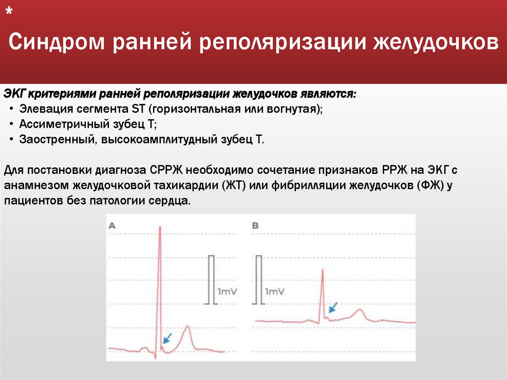 Синдром ранней реполяризации желудочков