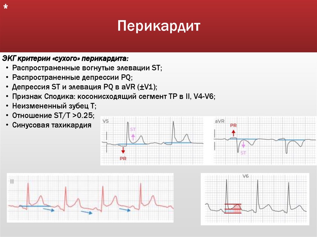 Перикардит