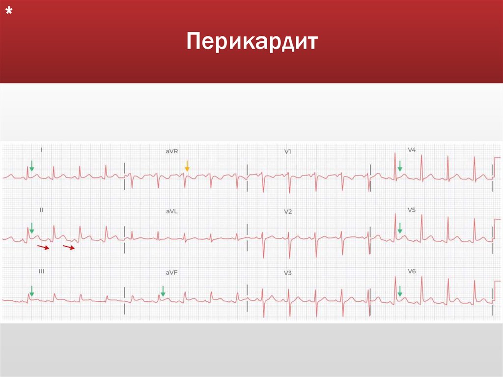 Перикардит