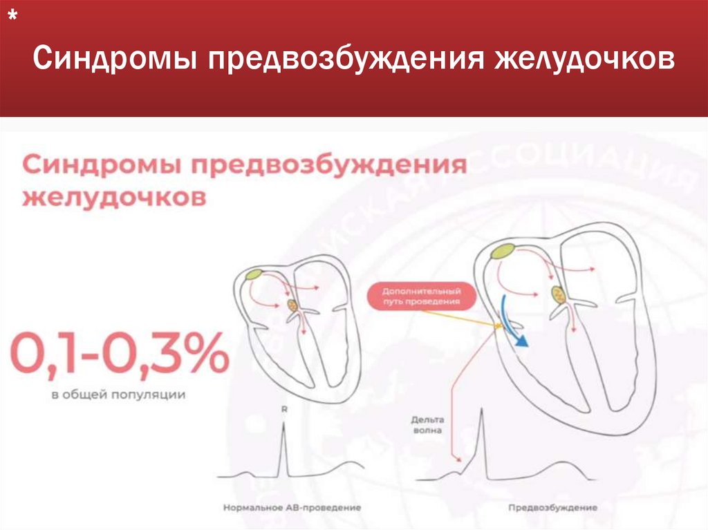 Синдромы предвозбуждения желудочков