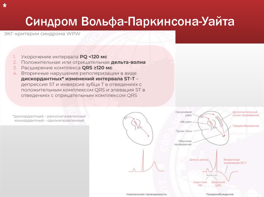 Синдром Вольфа-Паркинсона-Уайта