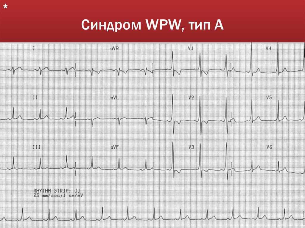 Синдром WPW, тип А