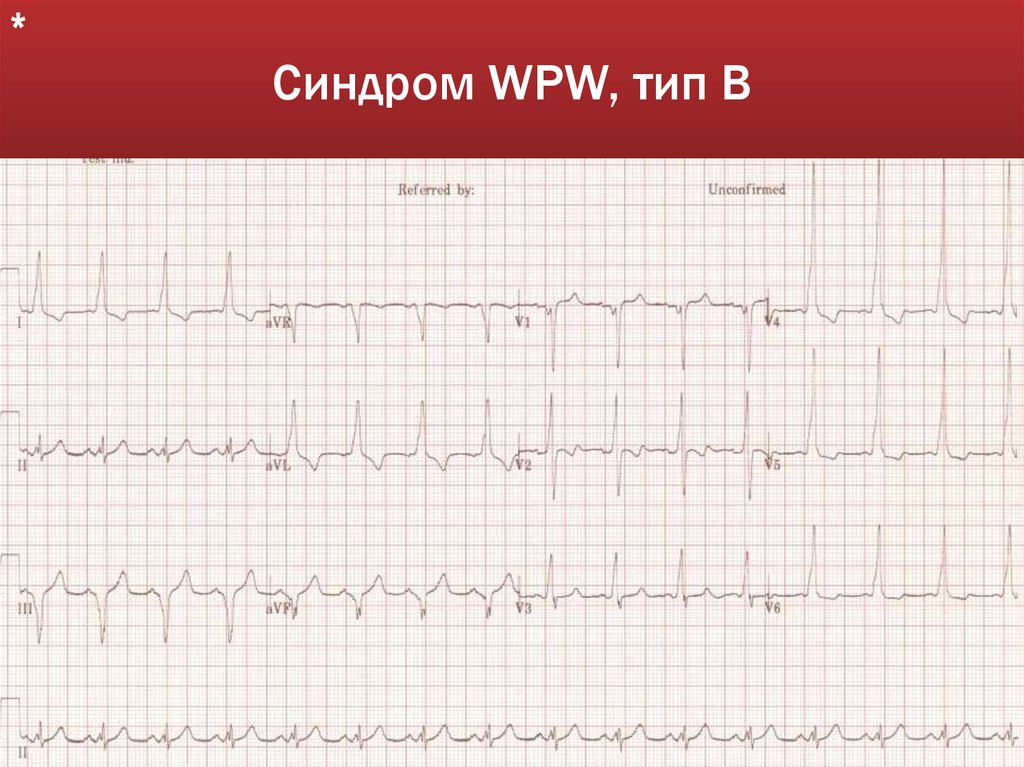 Синдром WPW, тип В