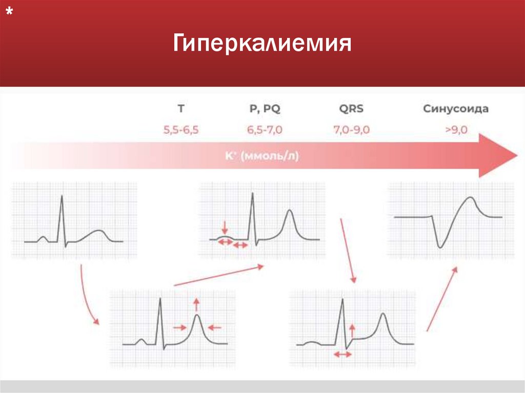 Гиперкалиемия