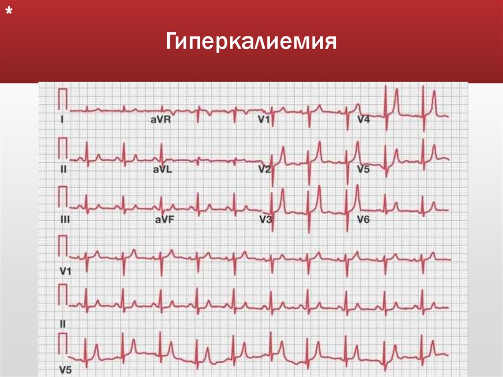 Гиперкалиемия