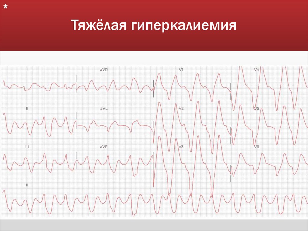 Тяжёлая гиперкалиемия
