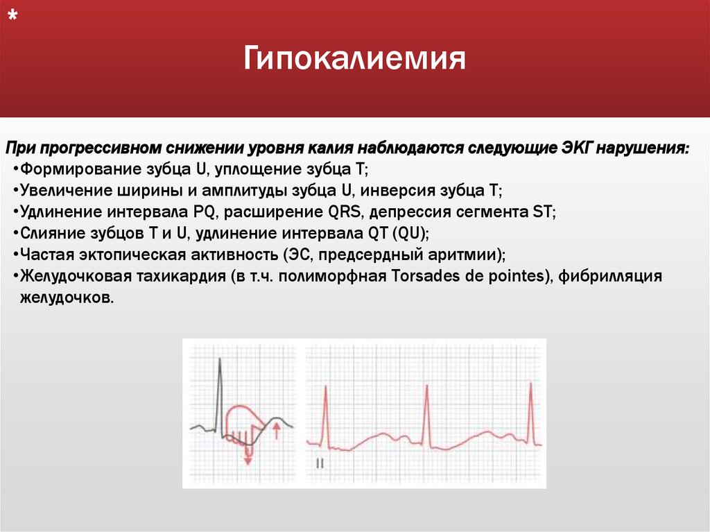 Гипокалиемия