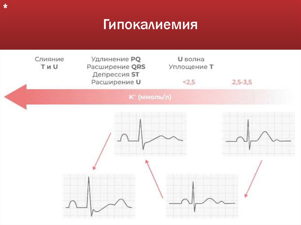 Гипокалиемия