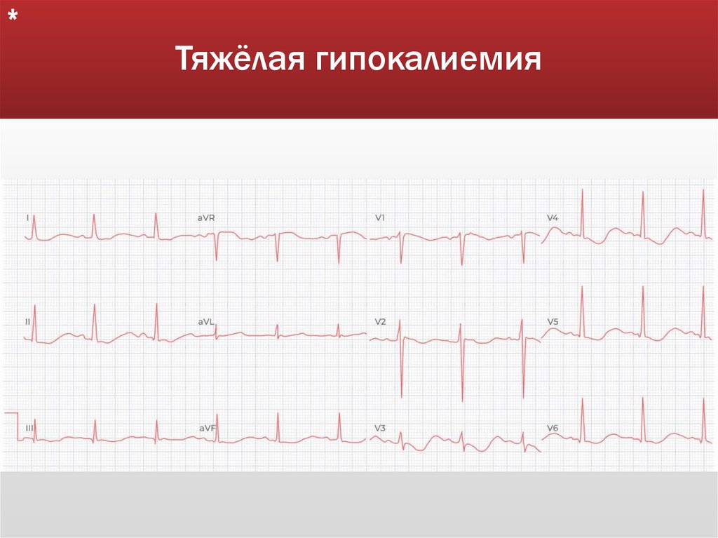 Тяжёлая гипокалиемия