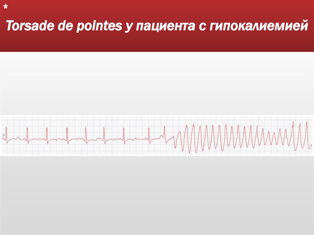 Torsade de pointes у пациента с гипокалиемией