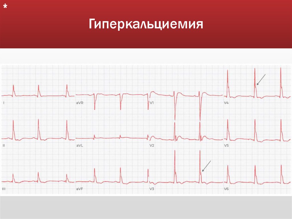 Гиперкальциемия
