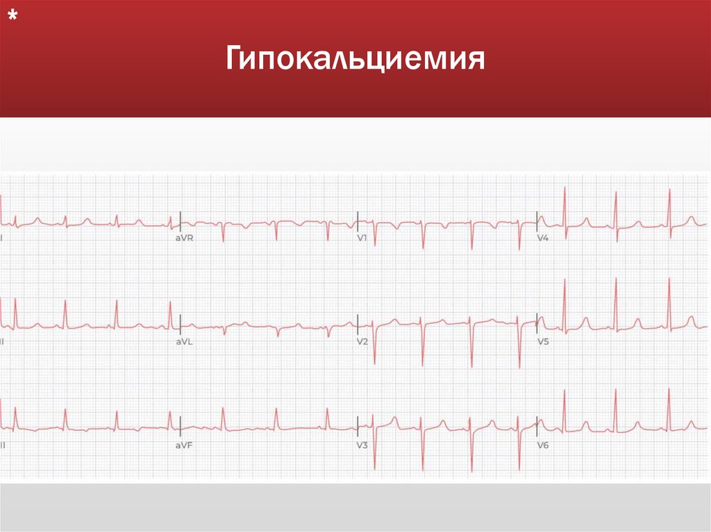 Гипокальциемия