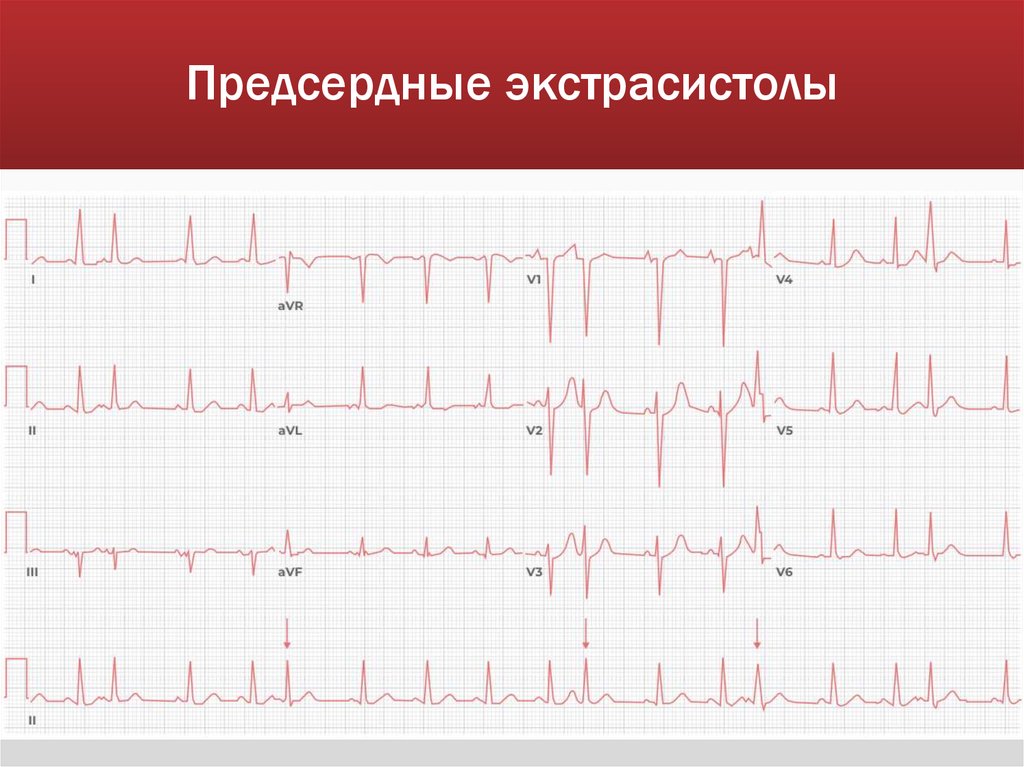 Предсердные экстрасистолы