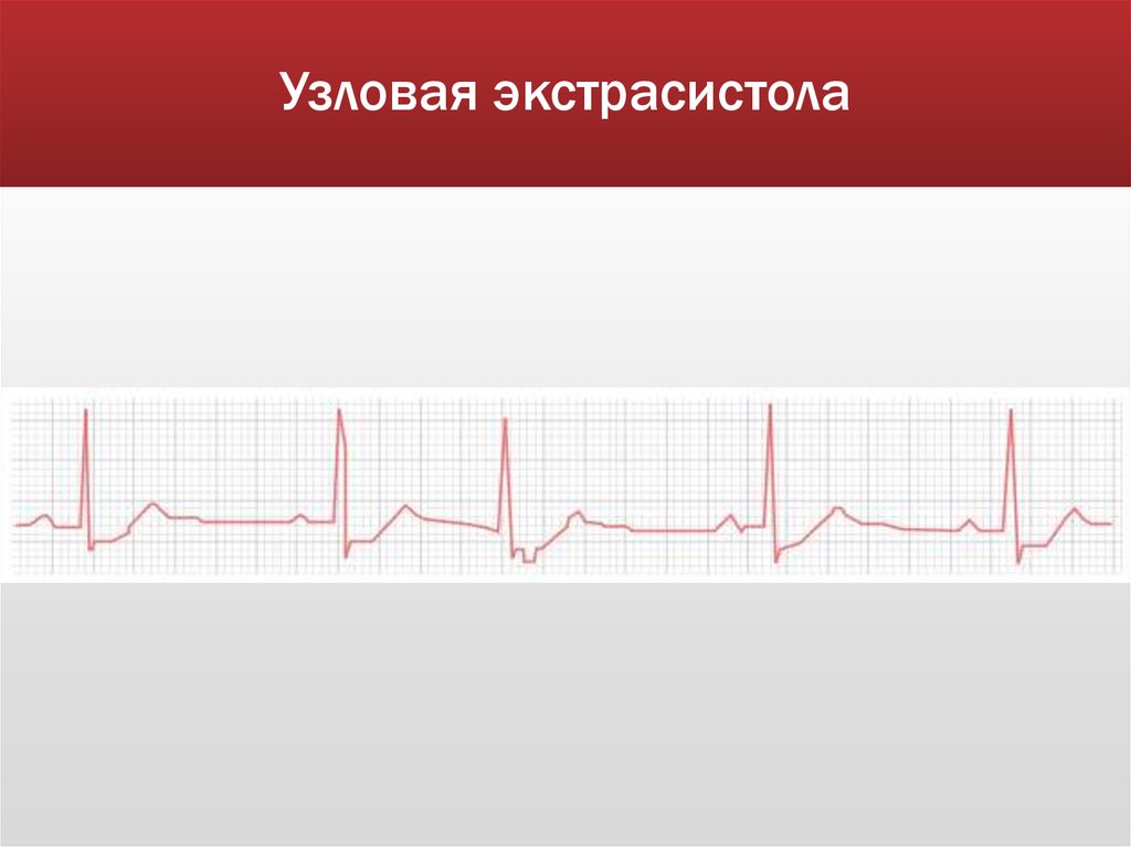 Узловая экстрасистола