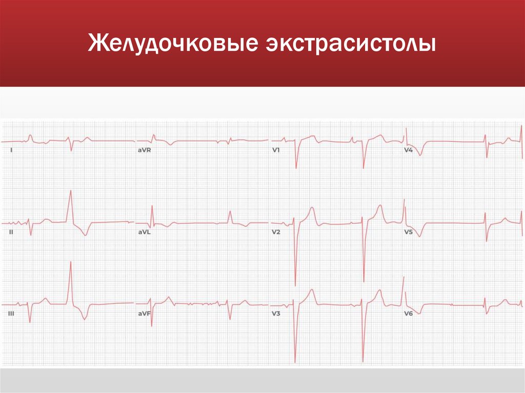 Желудочковые экстрасистолы