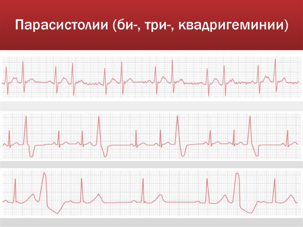 Парасистолии (би-, три-, квадригеминии)